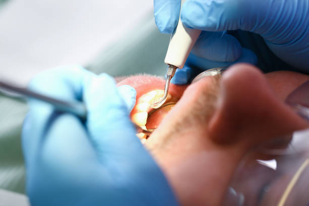 Best Emergency Treatment for Dental Infections or Abscesses in Harrington, DE