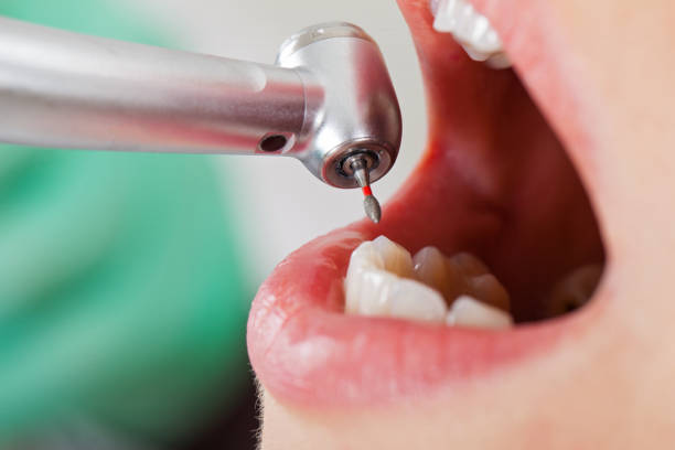 Best Emergency Tooth Extraction in Harrington, DE